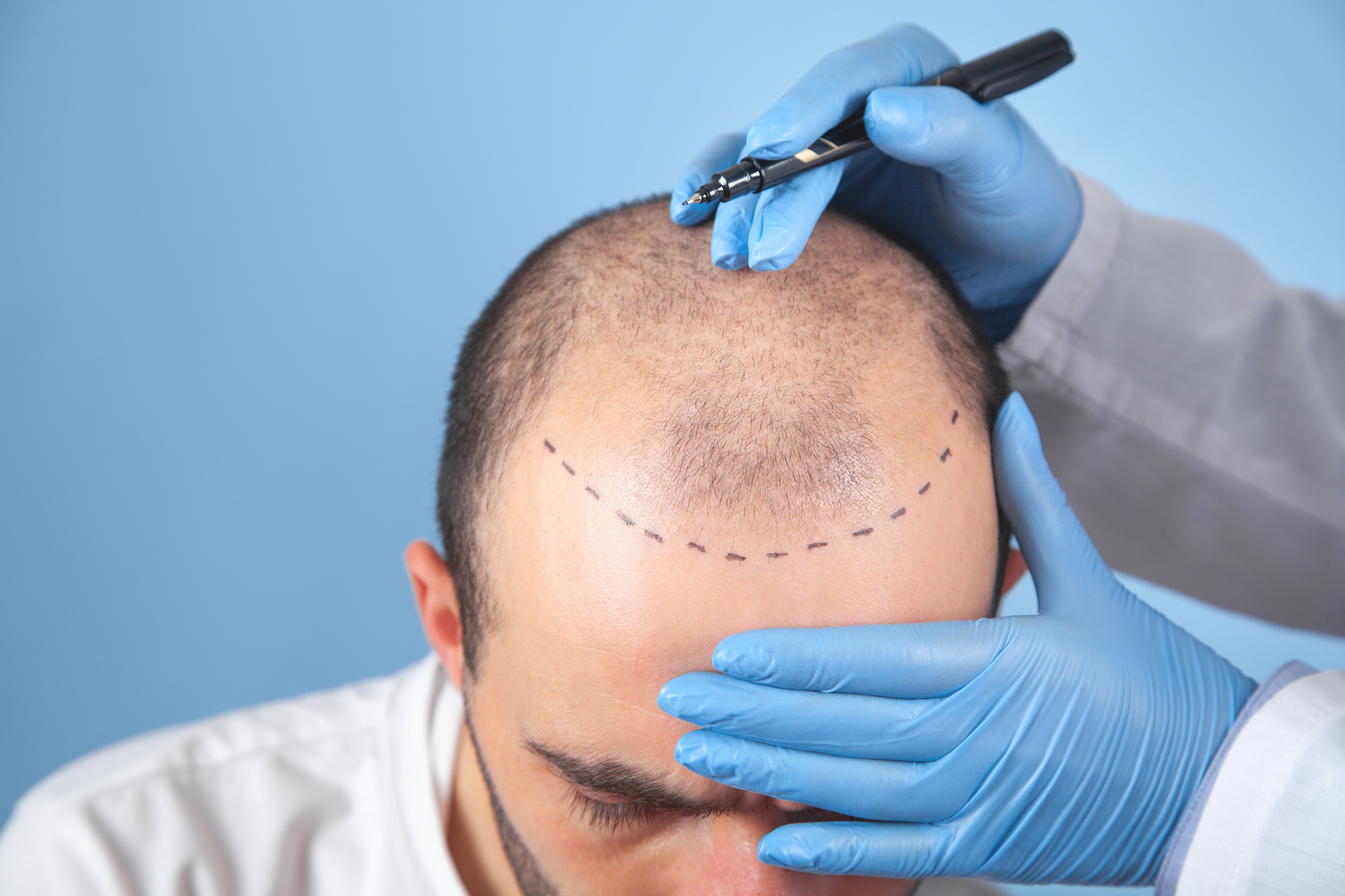 Hair Transplant